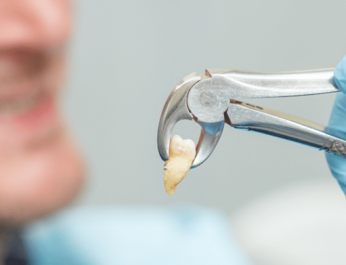 Understanding Tooth Extractions